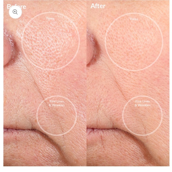 Personal Microderm Pro Clinical-Grade Exfoliation
At-Home Microdermabrasion - Picture 8 of 11